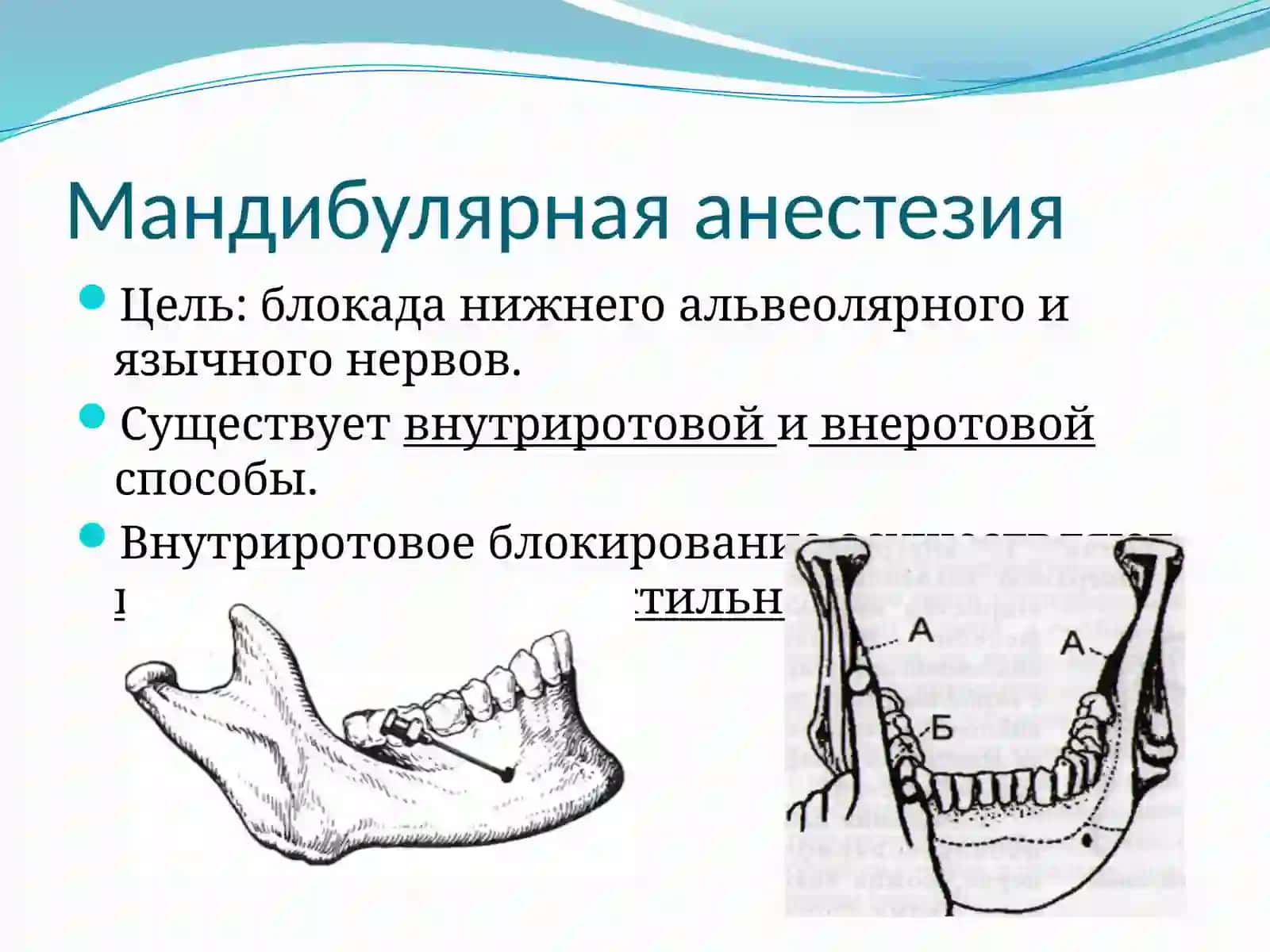 Мандибулярная иторусальная анестезия 2
