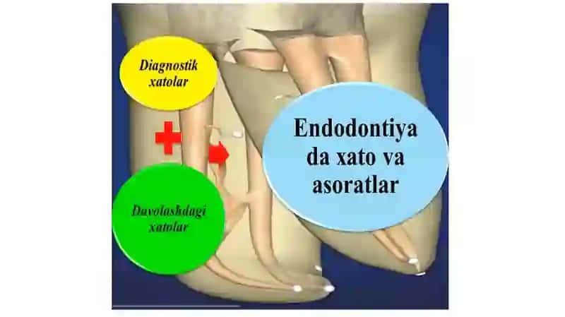 Klinik endodontiyada xato va asoratlar 2