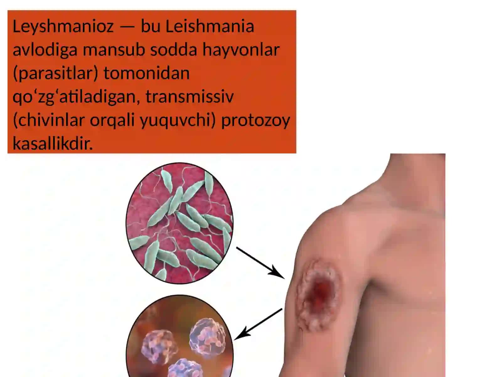 Leyshmanioz 2
