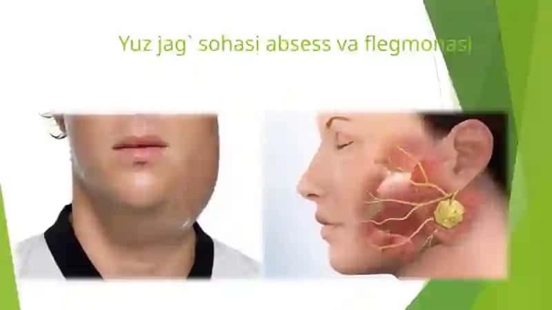 Yuzjag` sohasi absess va flegmonasi 2