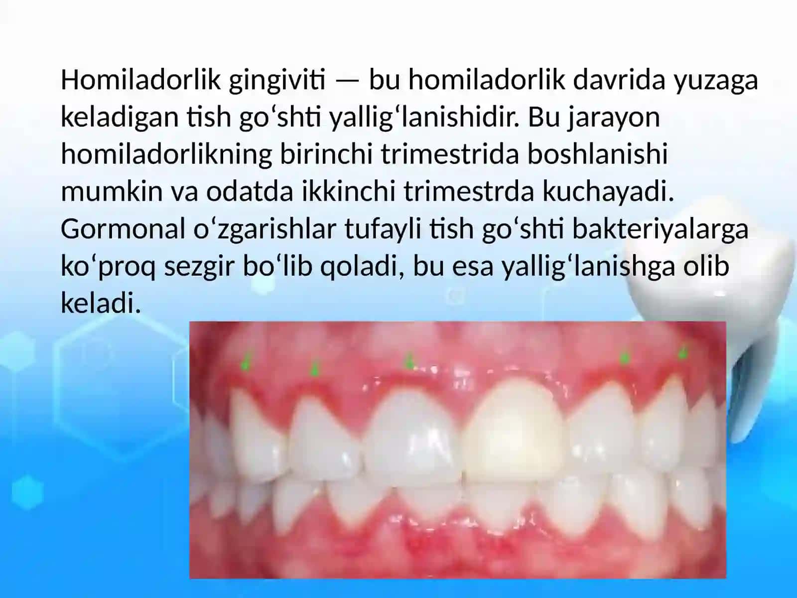 Homiladorlar gingiviti 2