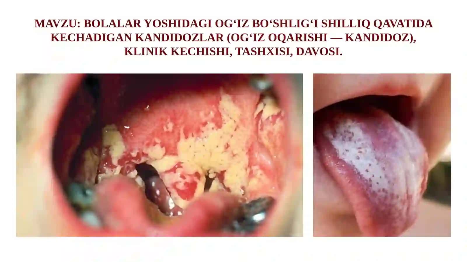 OG‘IZ BO‘SHLIG‘I SHILLIQ QAVATIDA KECHADIGAN KANDIDOZLAR 2