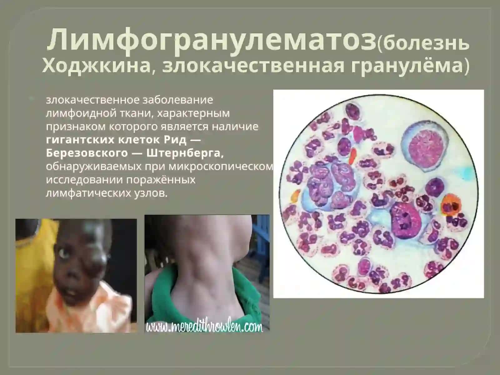 Лимфогранулематоз 2