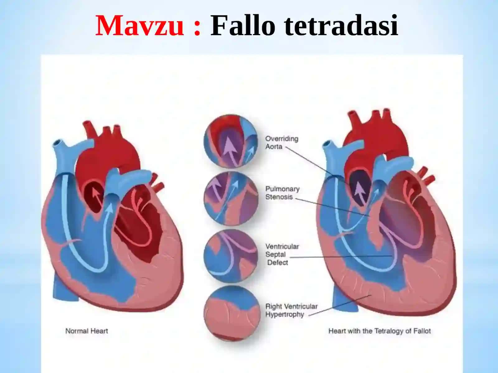 Fallot Tetradasi - Patologik Anatomiya 2