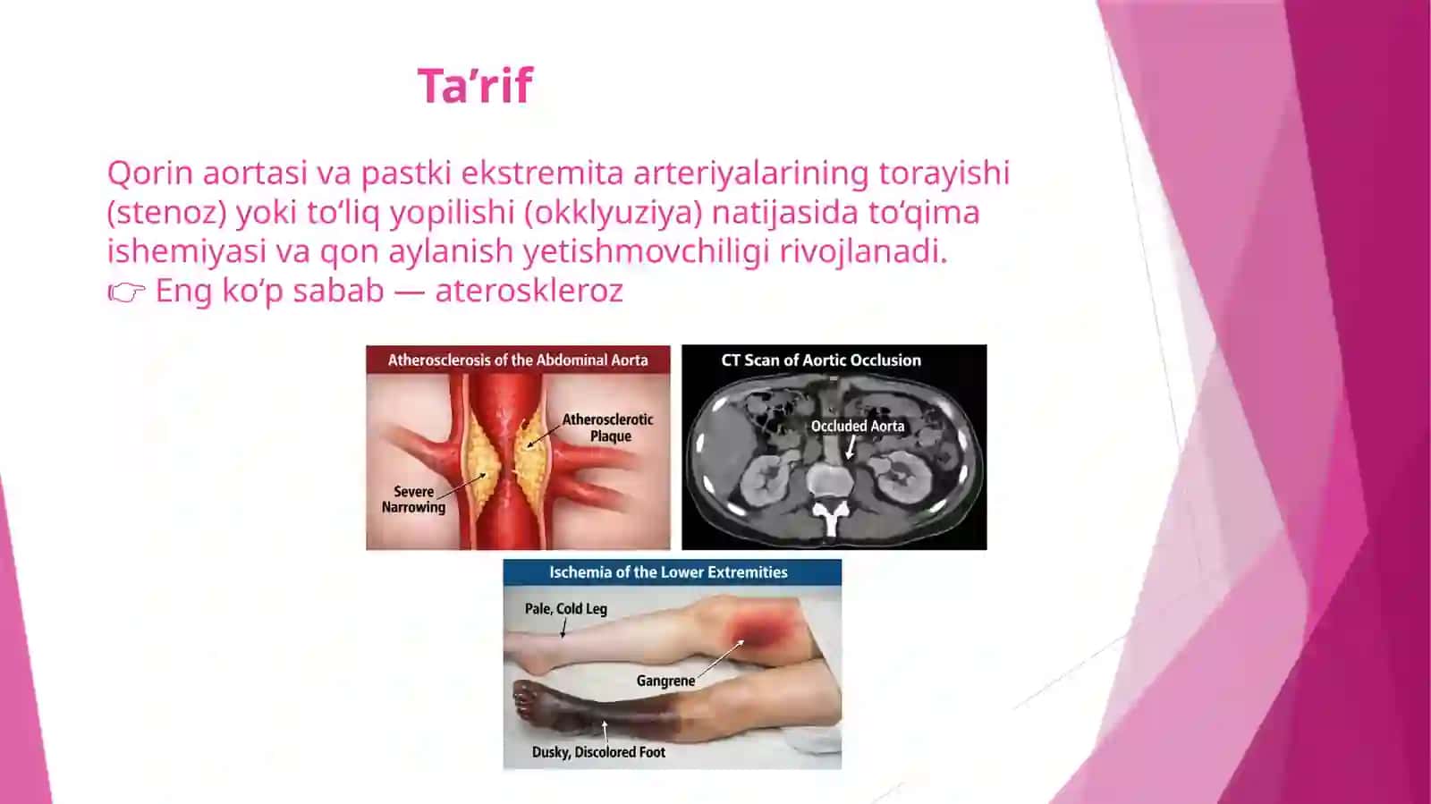 Qorin aortasi va oyoq arteriyalari okklyuzion kasalliklari. Endovaskulyar xirurgiya 2
