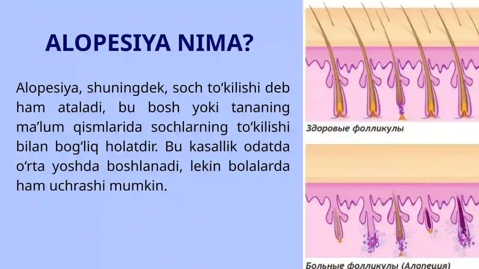 ALOPESIYANING ZAMONAVIY DAVOLASH USULLARI 2