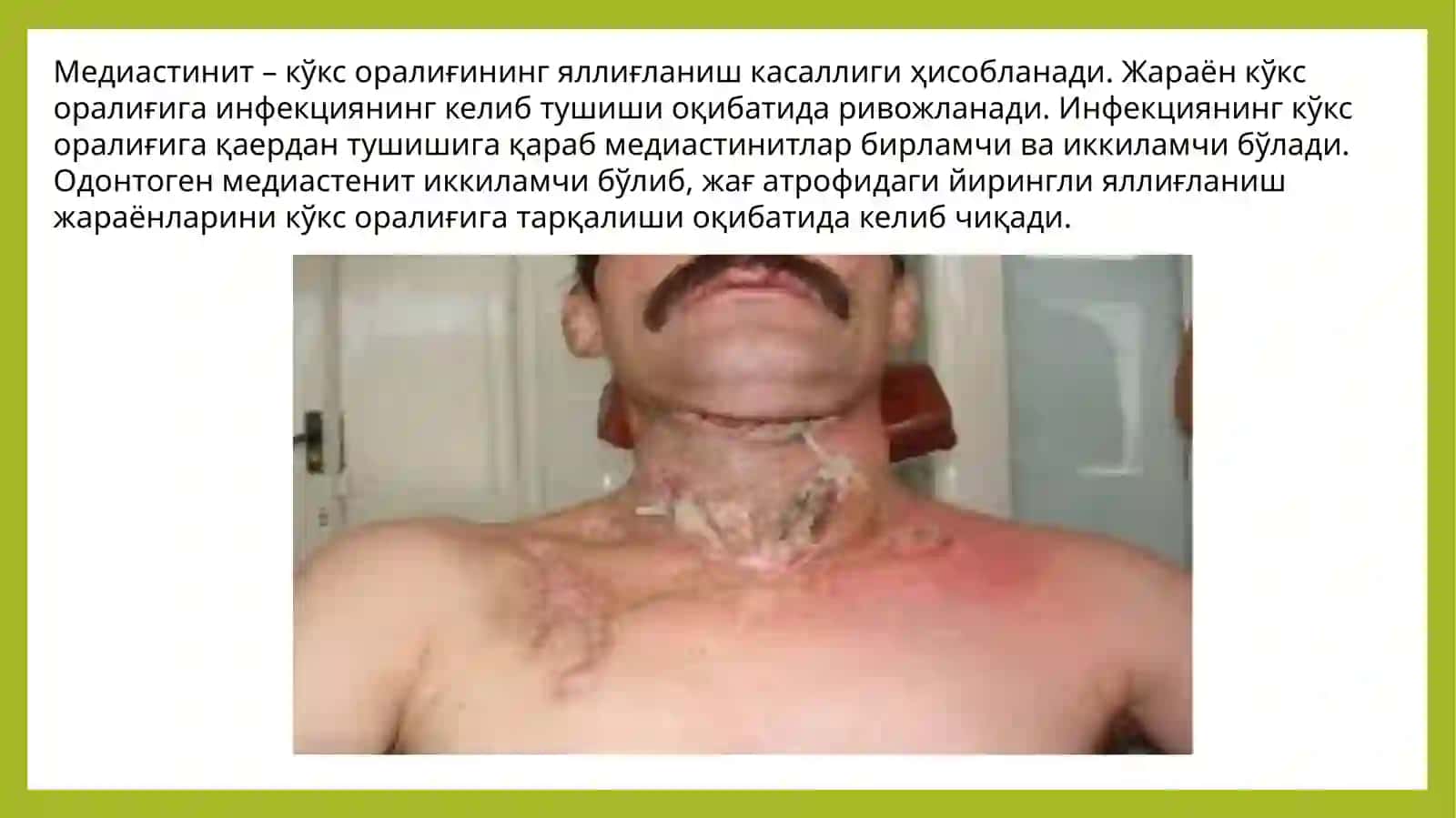 Медиастинит – кўксоралиғининг яллиғланишкасаллиги 2