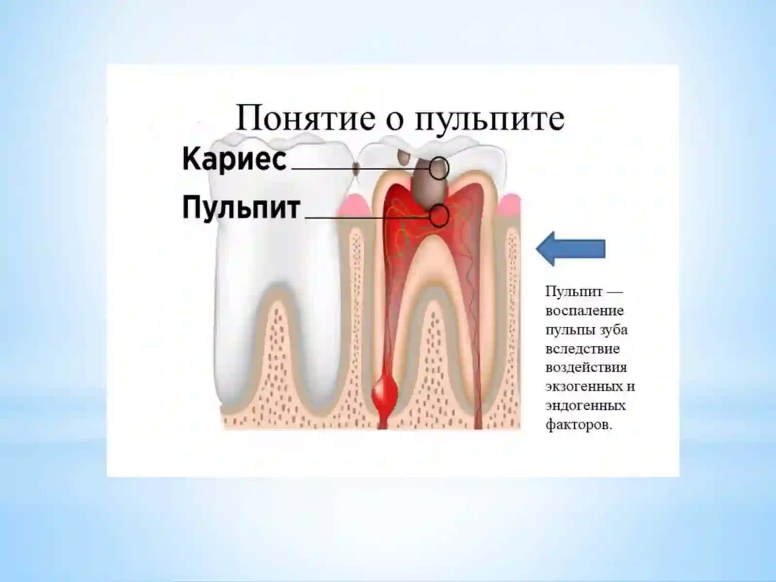 Острый очаговыйпульпит,острыйдиффузный пульпит –клиника,диагностика 2