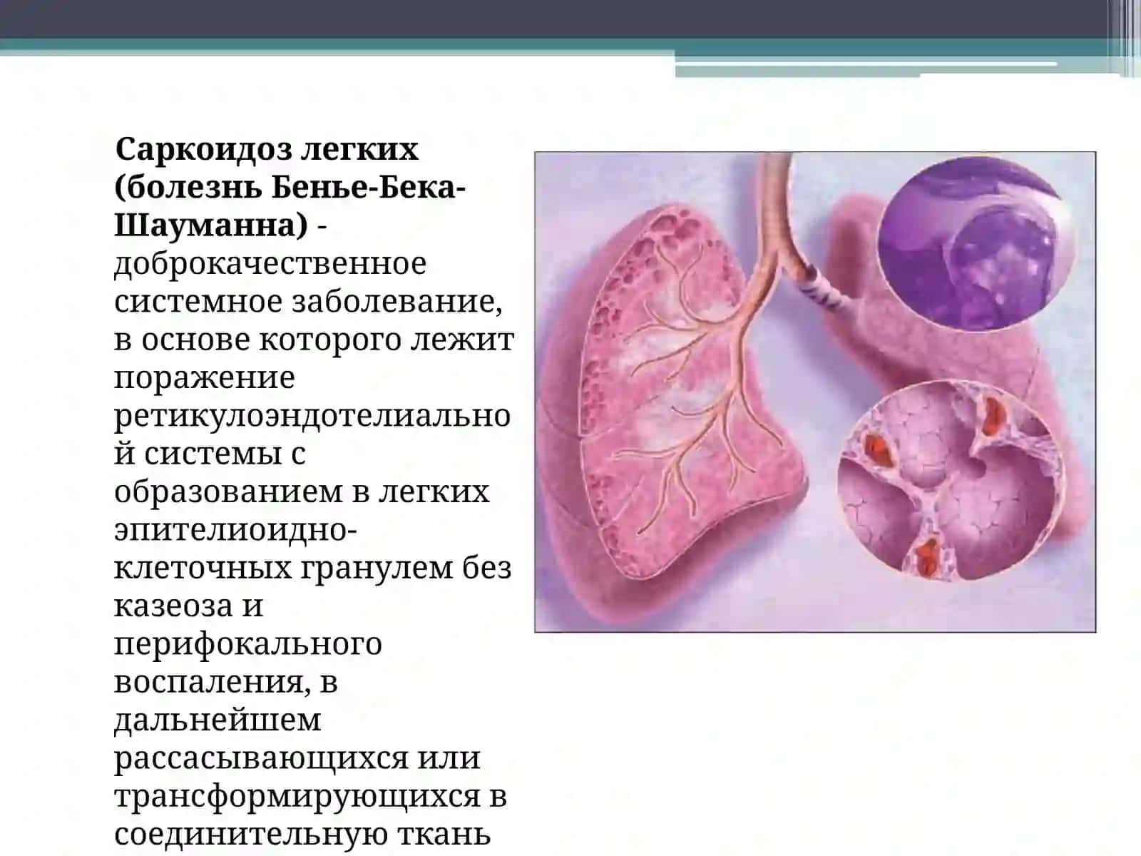 Саркоидоз легких (болезнь Бенье-Бека-Шауманна) 2