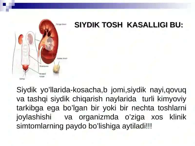 SIYDIK TOSH KASALLIGI 2