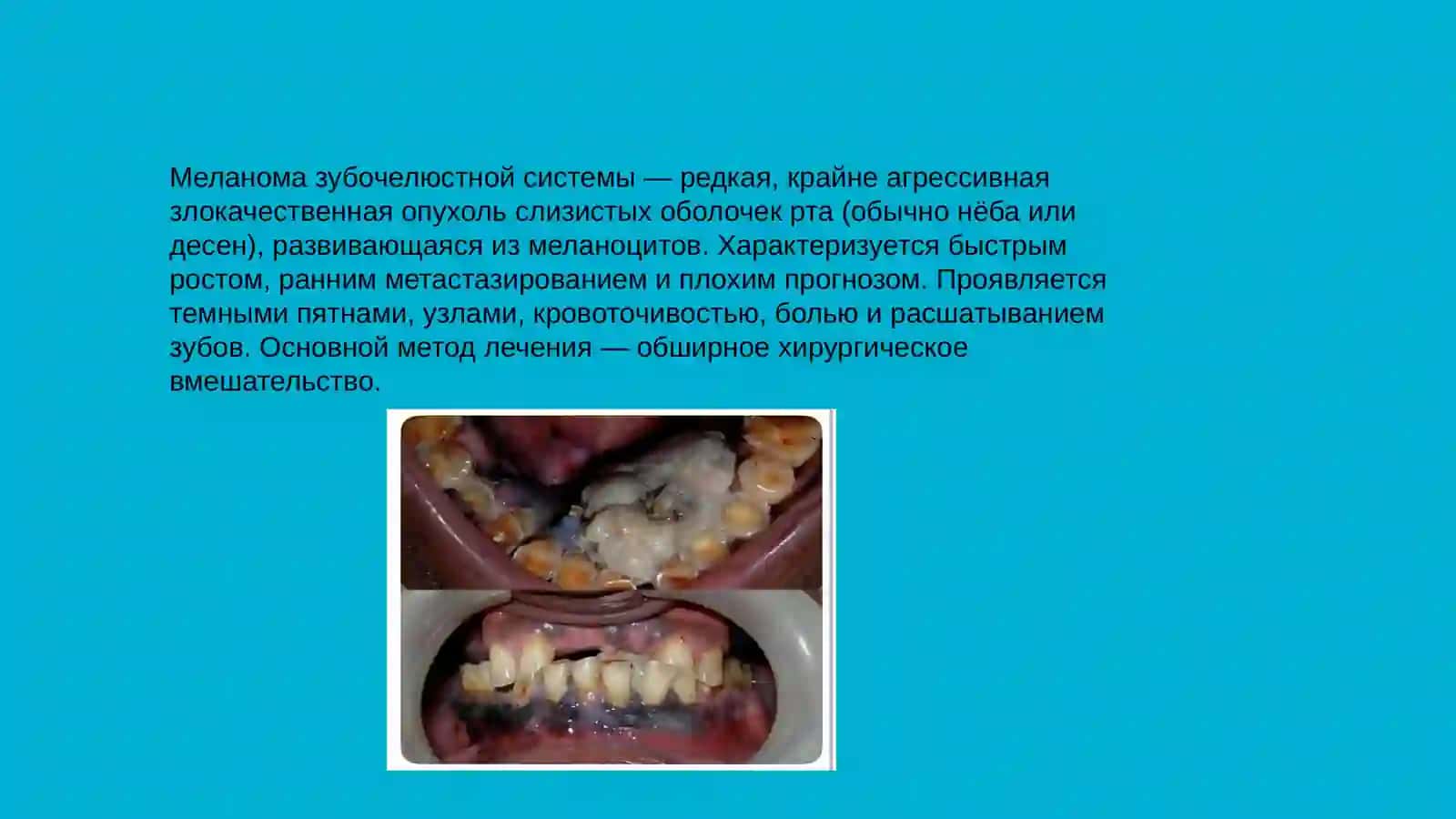 Меланом зубочелюстной системы, их морфология 2