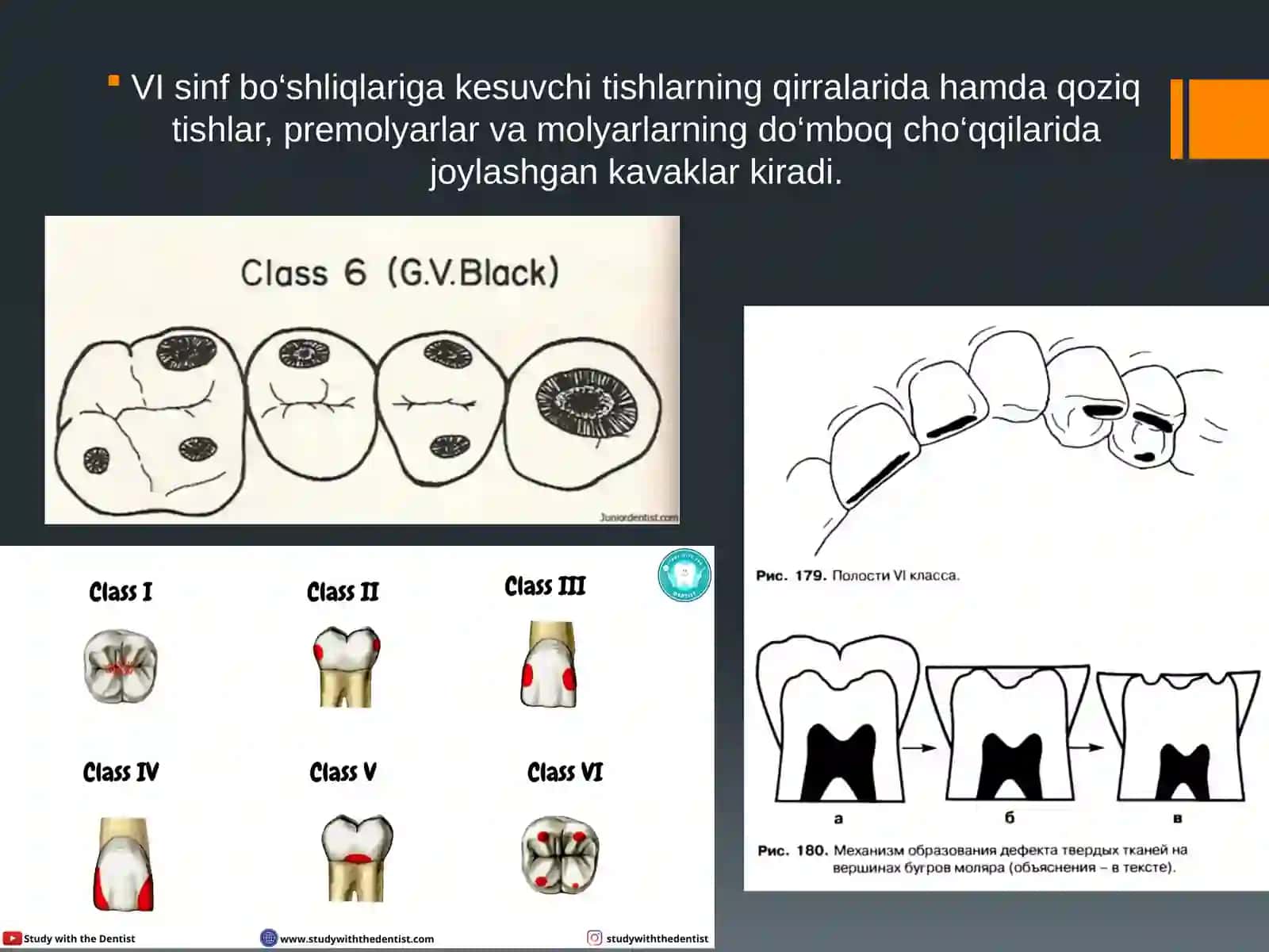 Blek bo‘yicha VI sinfli karies kovaklarini restavratsiya qilishning klinik tamoyillari 2