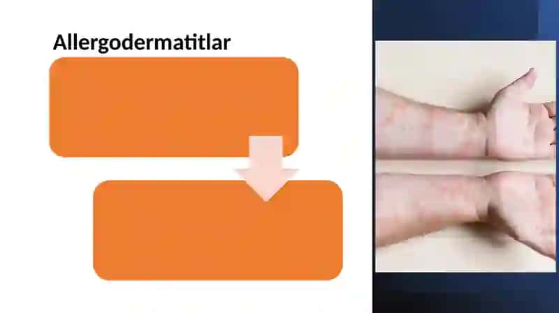 allergiyalar 2