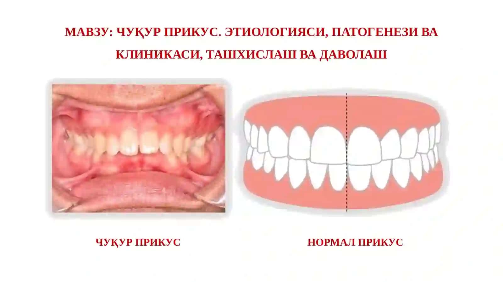 ЧУҚУР ПРИКУС. ЭТИОЛОГИЯСИ, ПАТОГEНEЗИ ВА КЛИНИКАСИ, ТАШХИСЛАШ ВА ДАВОЛАШ 2