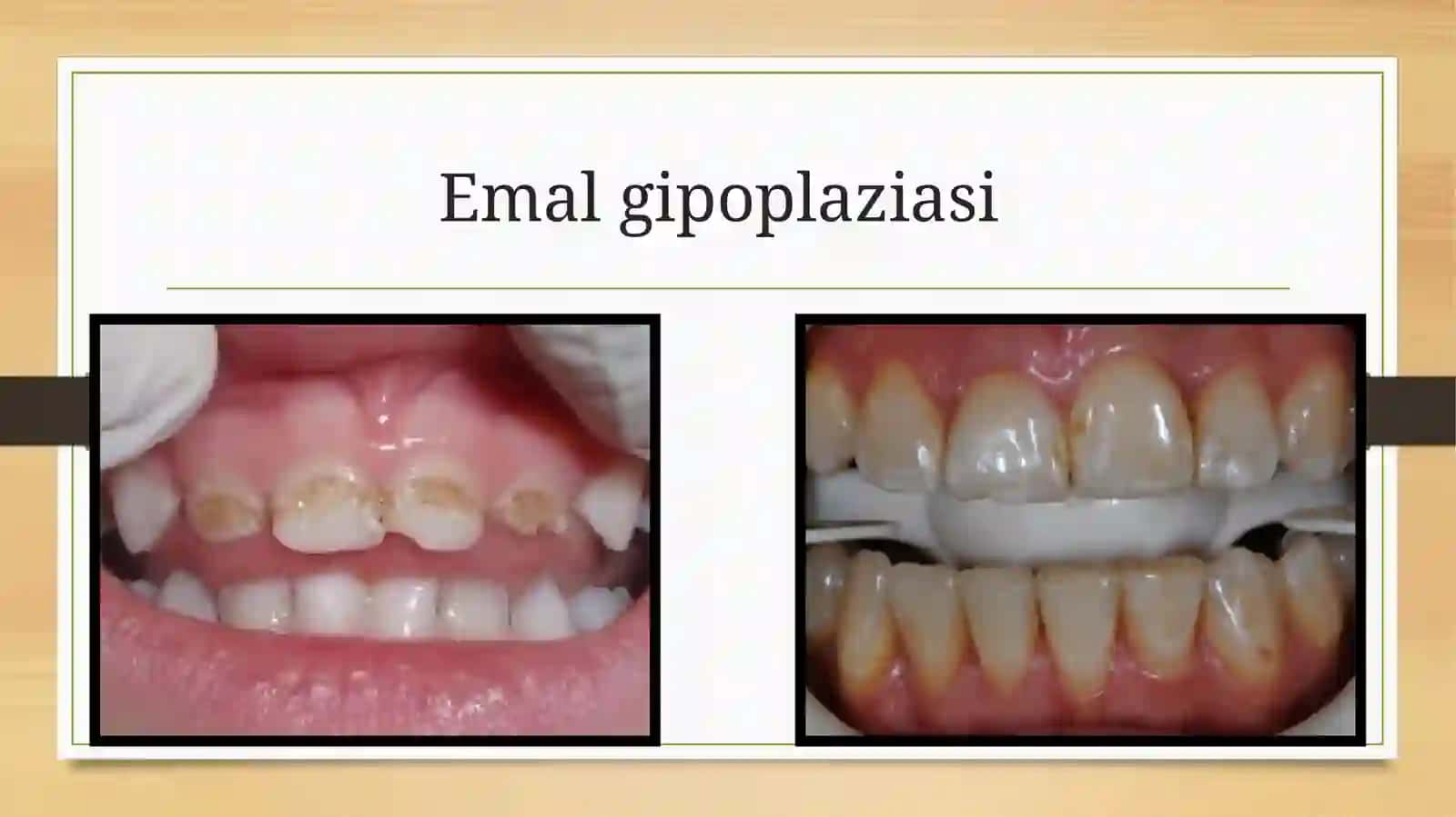 Emal gipoplaziasi 2