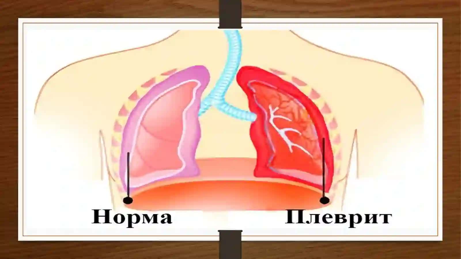 Plevritlaretiologiya 2
