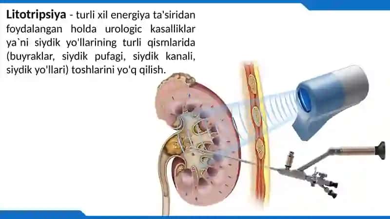 LitotripsiyaApparatlari 2