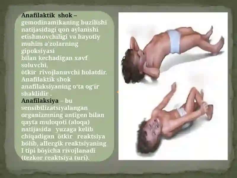 Anafilaktik shok 2