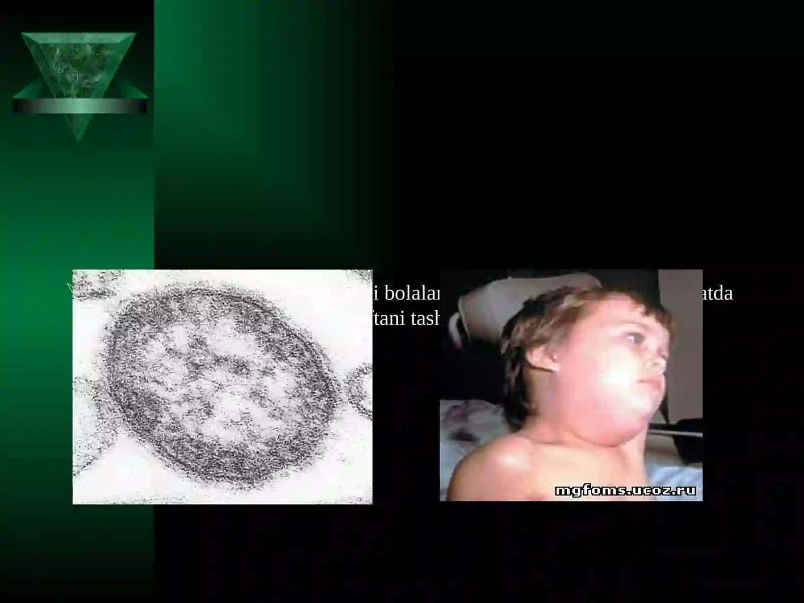 Epidemik parotit (tepki) kasalligi va asoratlari 2
