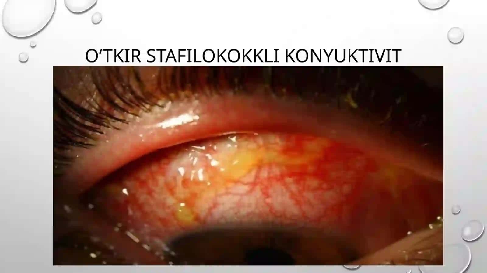 O‘tkir vasurunkalistafilokokklikonyuktivit 2