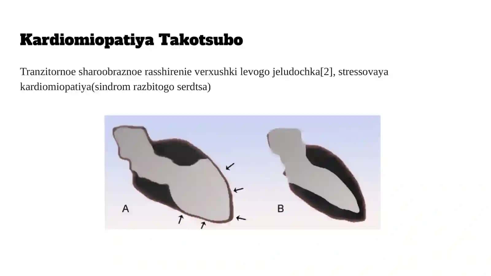 Takotsubo kardiomiopatiyasi (2-variant) 2