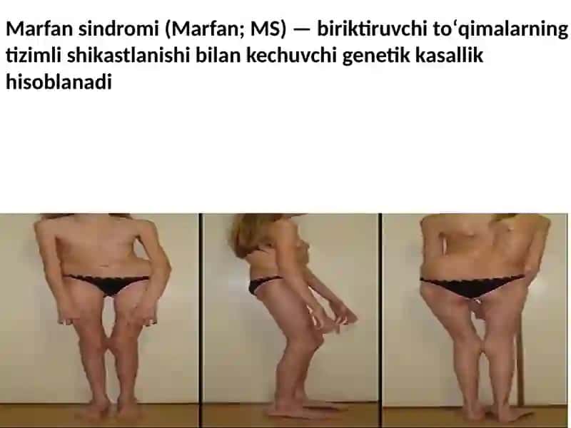 Marfan sindromi 2