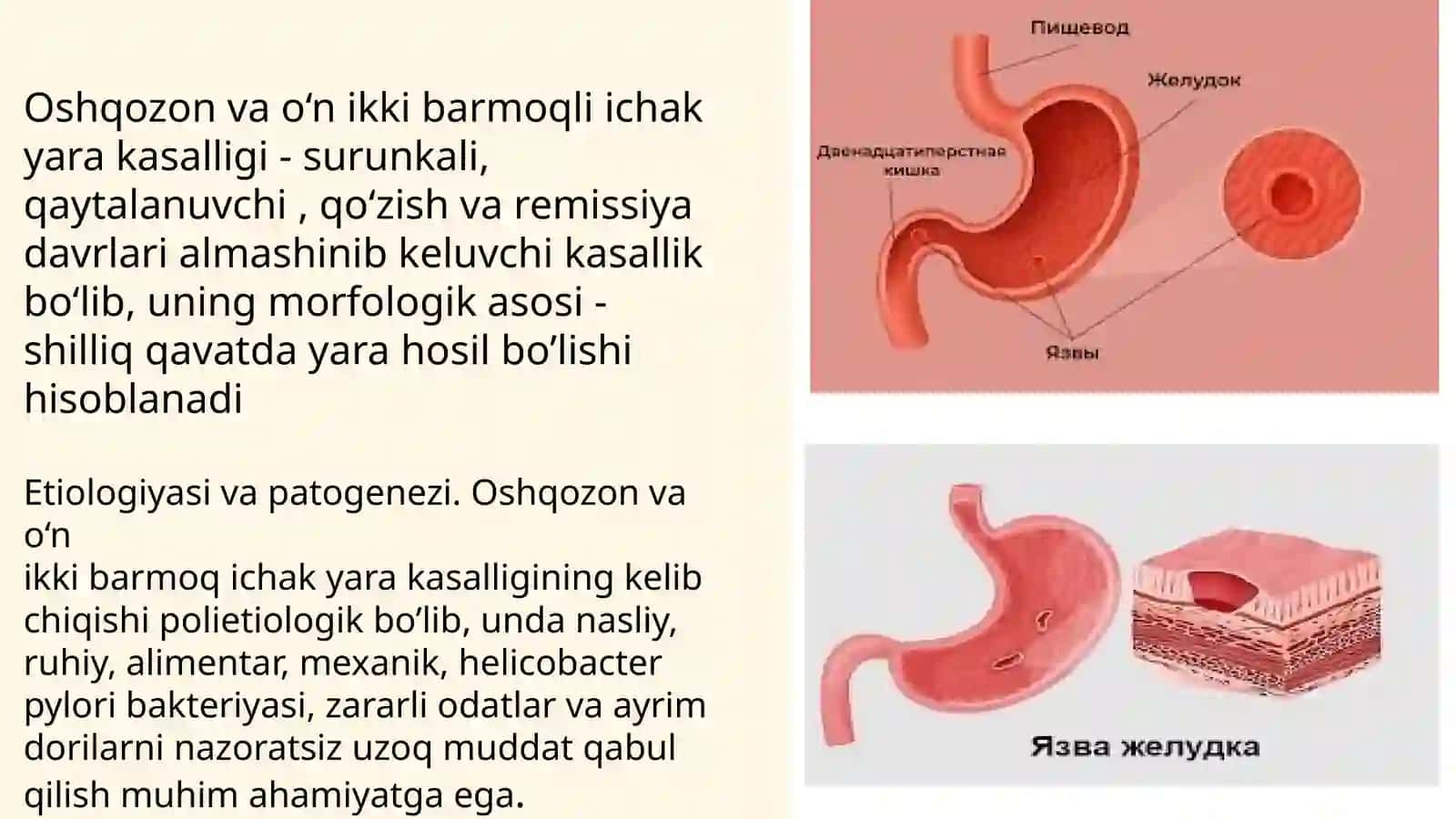 Oshqozon va o‘n ikki barmoqli ichak yara kasalligi 2