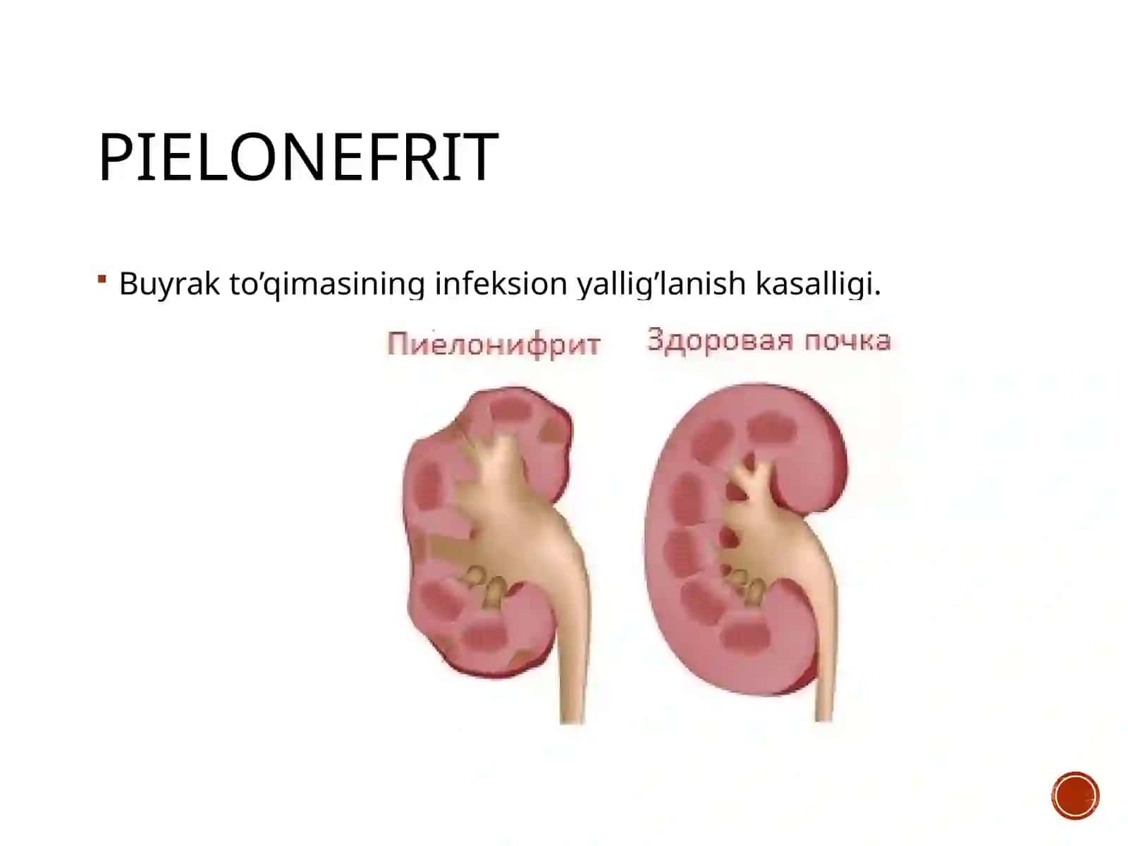 Siydik yo’llari yallig’lanish kasalliklari. Pielonefrit, sistit 2