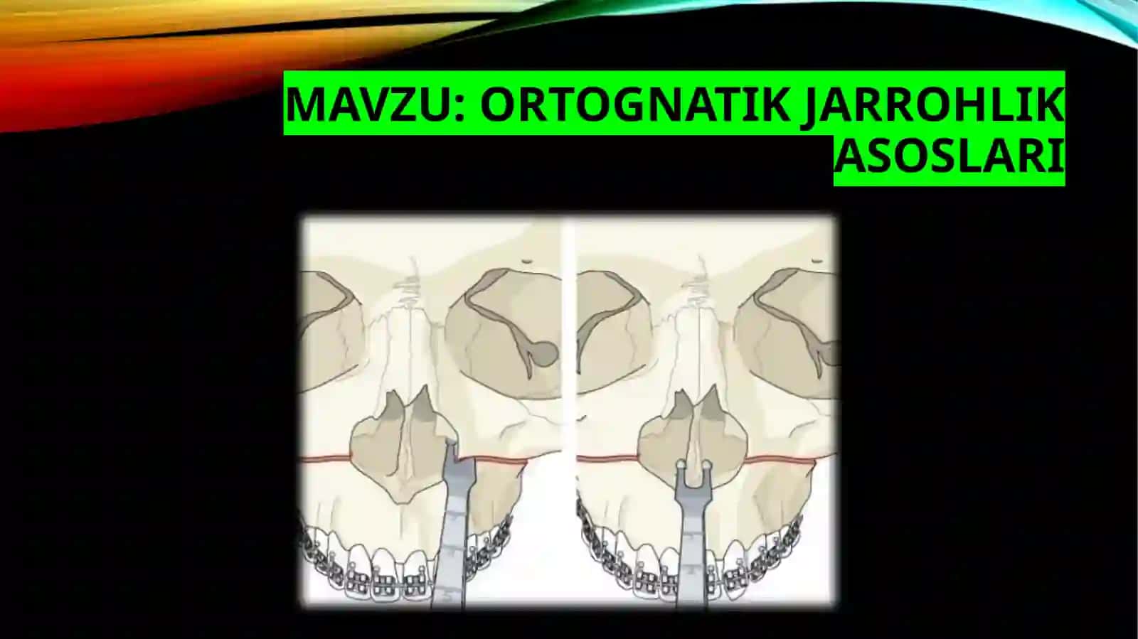 Ortognatik jarrohlik asoslari 2