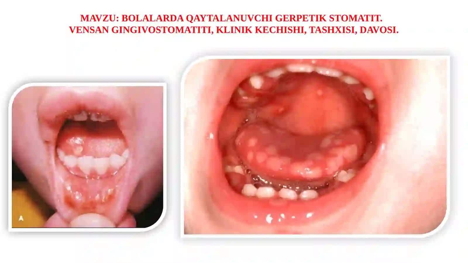 BOLALARDA QAYTALANUVCHI GERPETIK STOMATIT 2