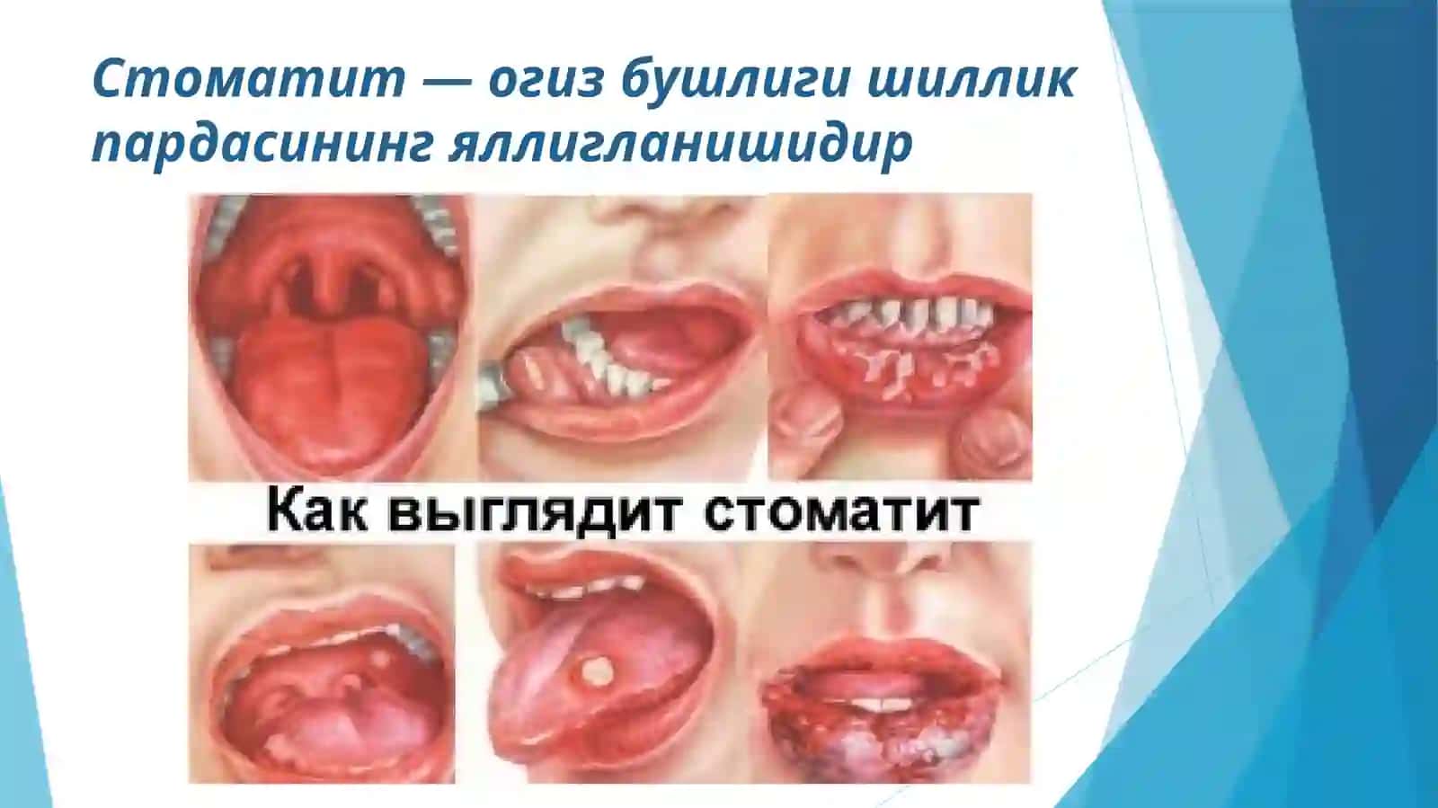 Стоматит 2