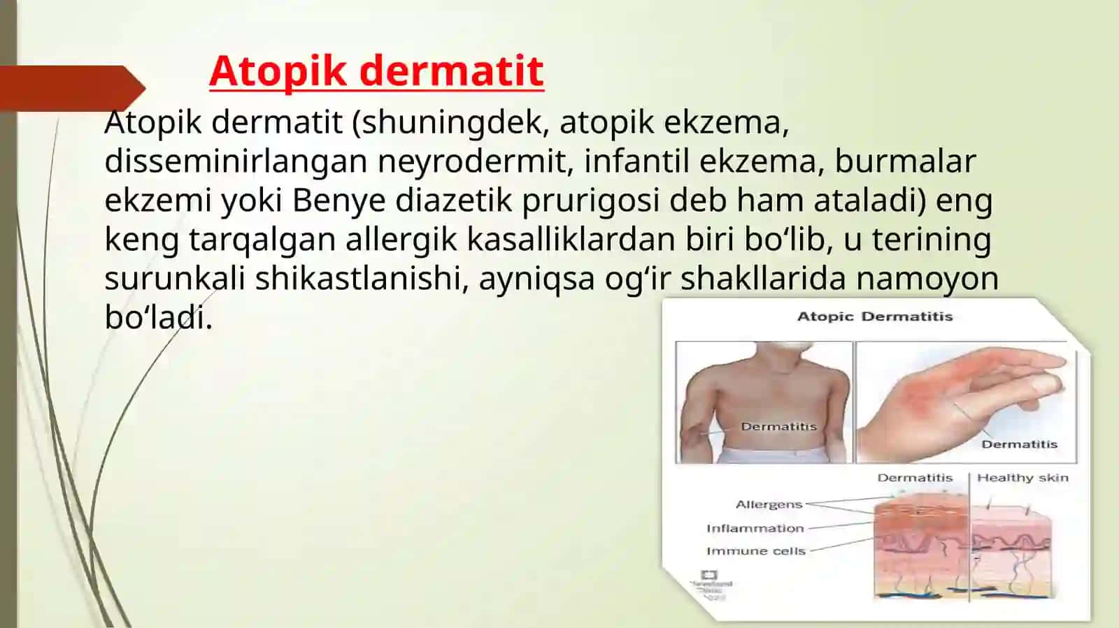 Atopik dermatitlar 2