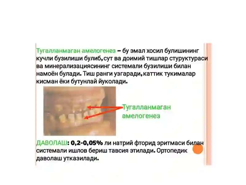 Tishtuzilmasining shakllanishi va irsiy buzilishlar 2