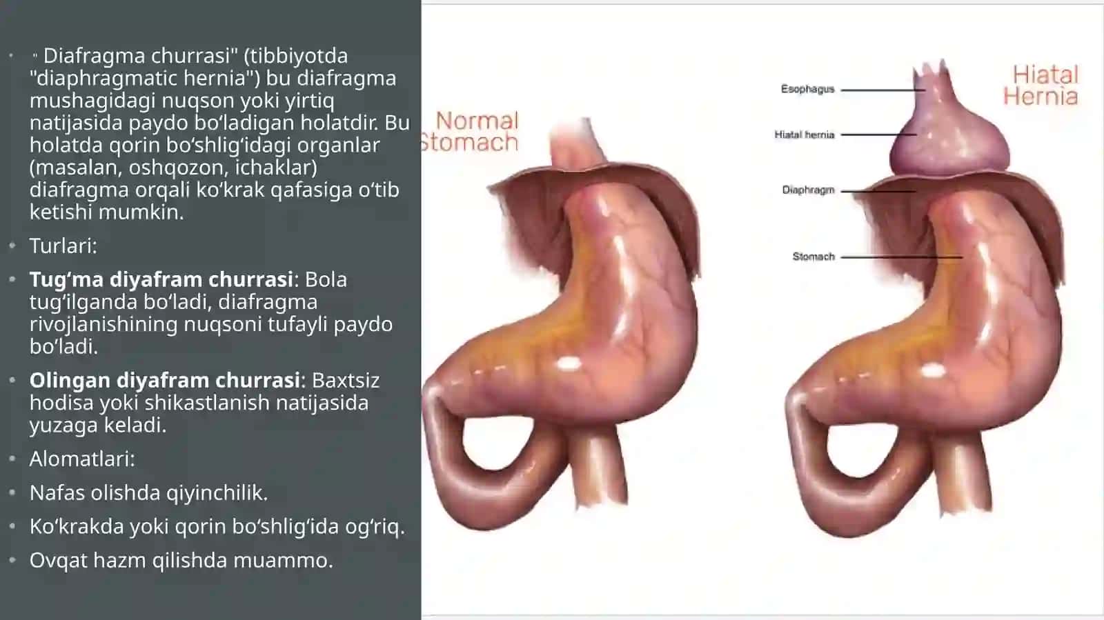 Diafragma churrasida nissen bo'yicha fundoplikatsiya amaliyoti 2