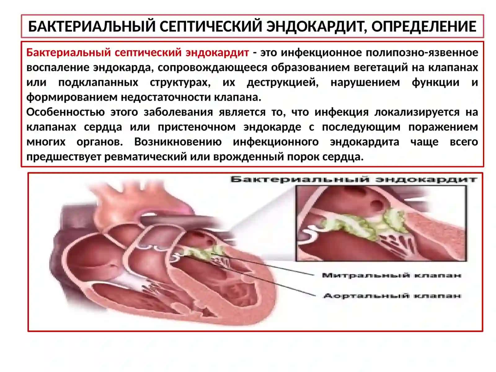 Бактериальный Септический Эндокардит, Определение 2