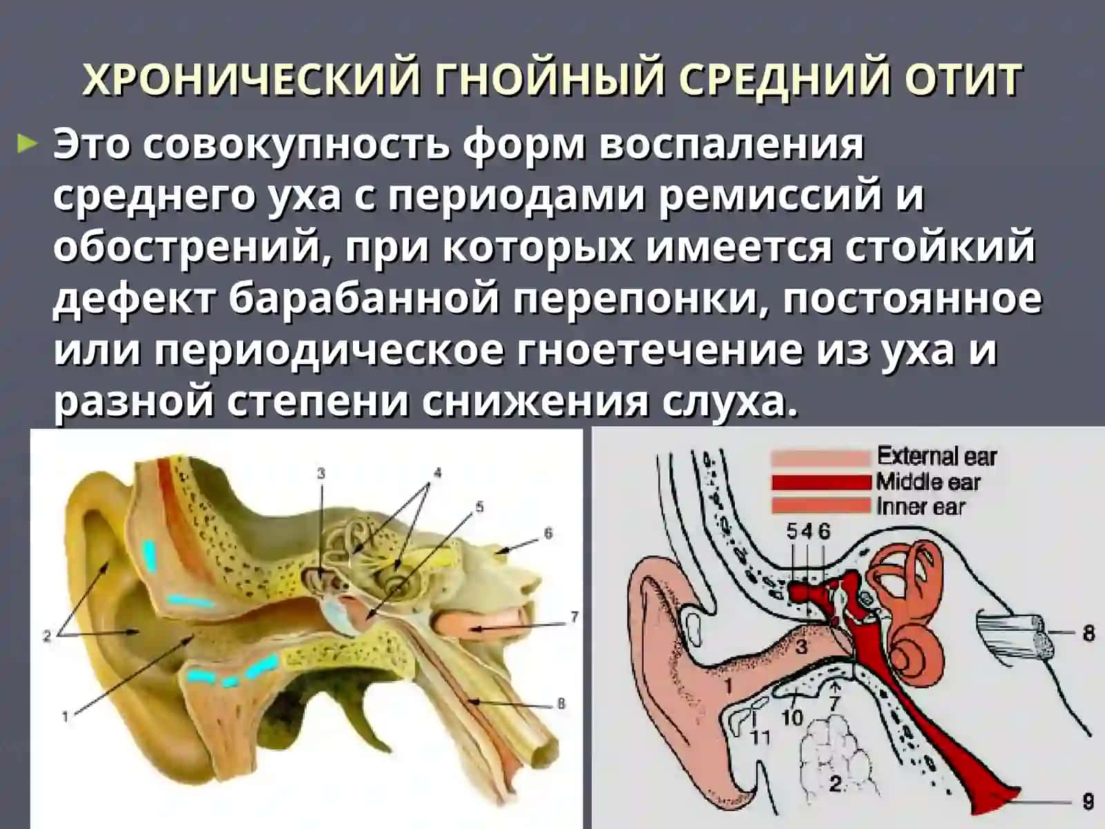 ХРОНИЧЕСКИЙ ГНОЙНЫЙ СРЕДНИЙ ОТИТ 2