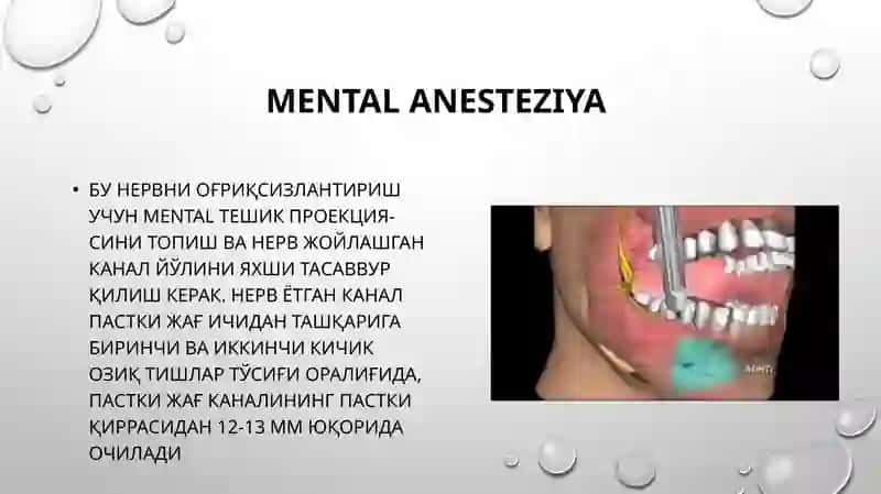 Mental Nervni Ogʻriqsizlantirish 2