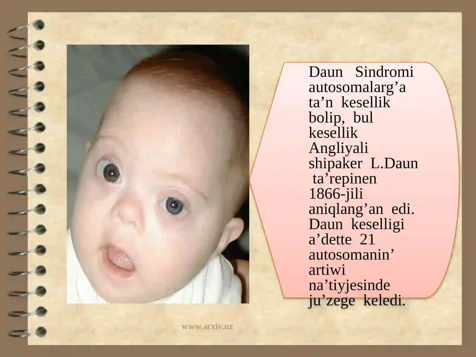 Xromosoma kesellikleri, Daun sindromi 2