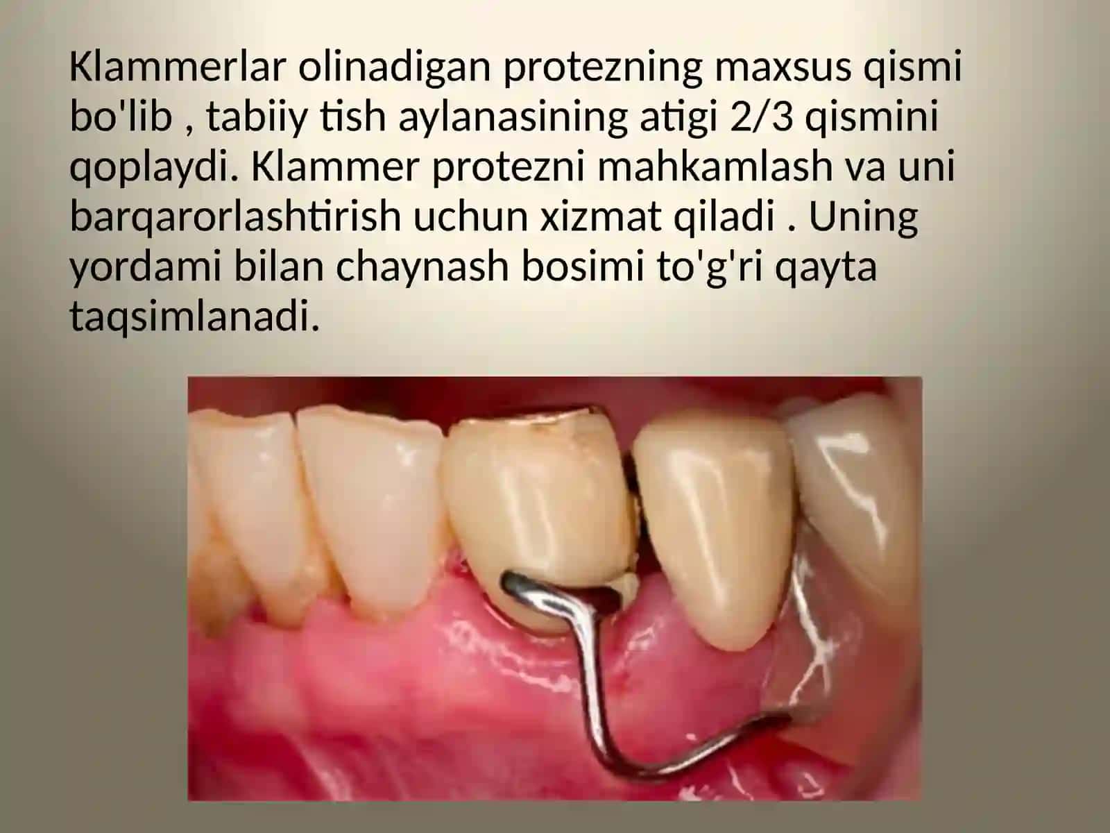 Qisman Olinadigan ortopedik pratezlarni fiksatsiyalash. Klammerlarning tuzilishi. 2