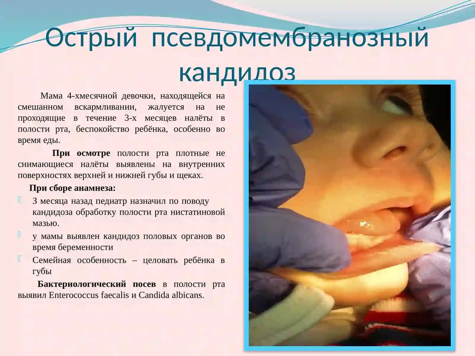 Кандидозы полости рта у новорожденных и детей раннего возраста 2