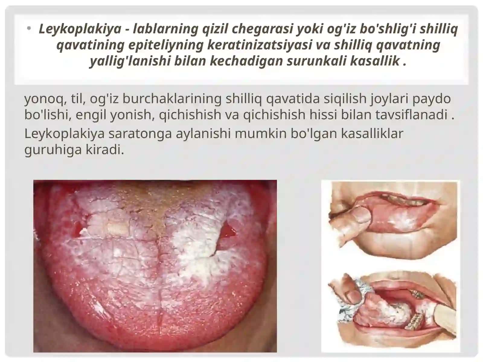 Leykoplakiya 2