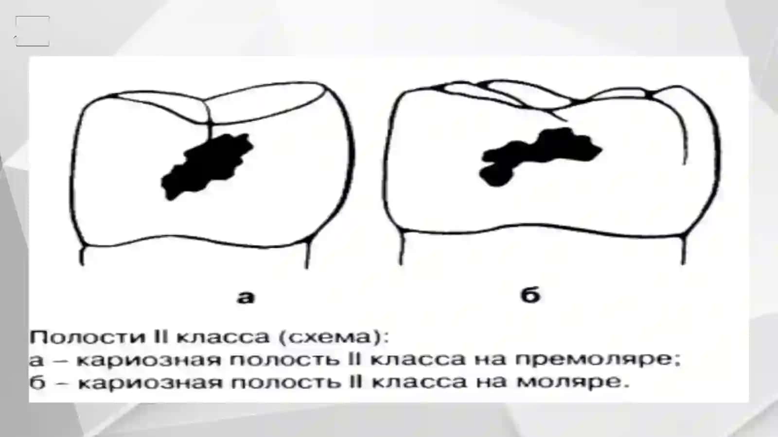 Fantomlarda 2-sinf karioz bo'shliqlarini charxlash va plombalash 2