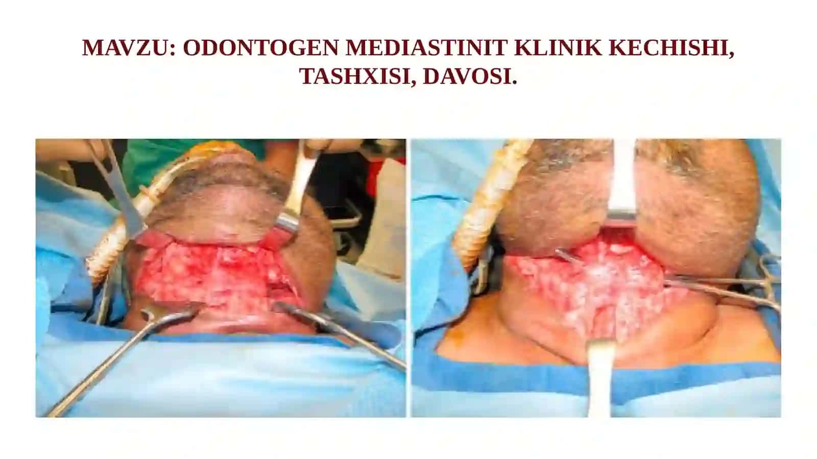 ODONTOGEN MEDIASTINIT 2