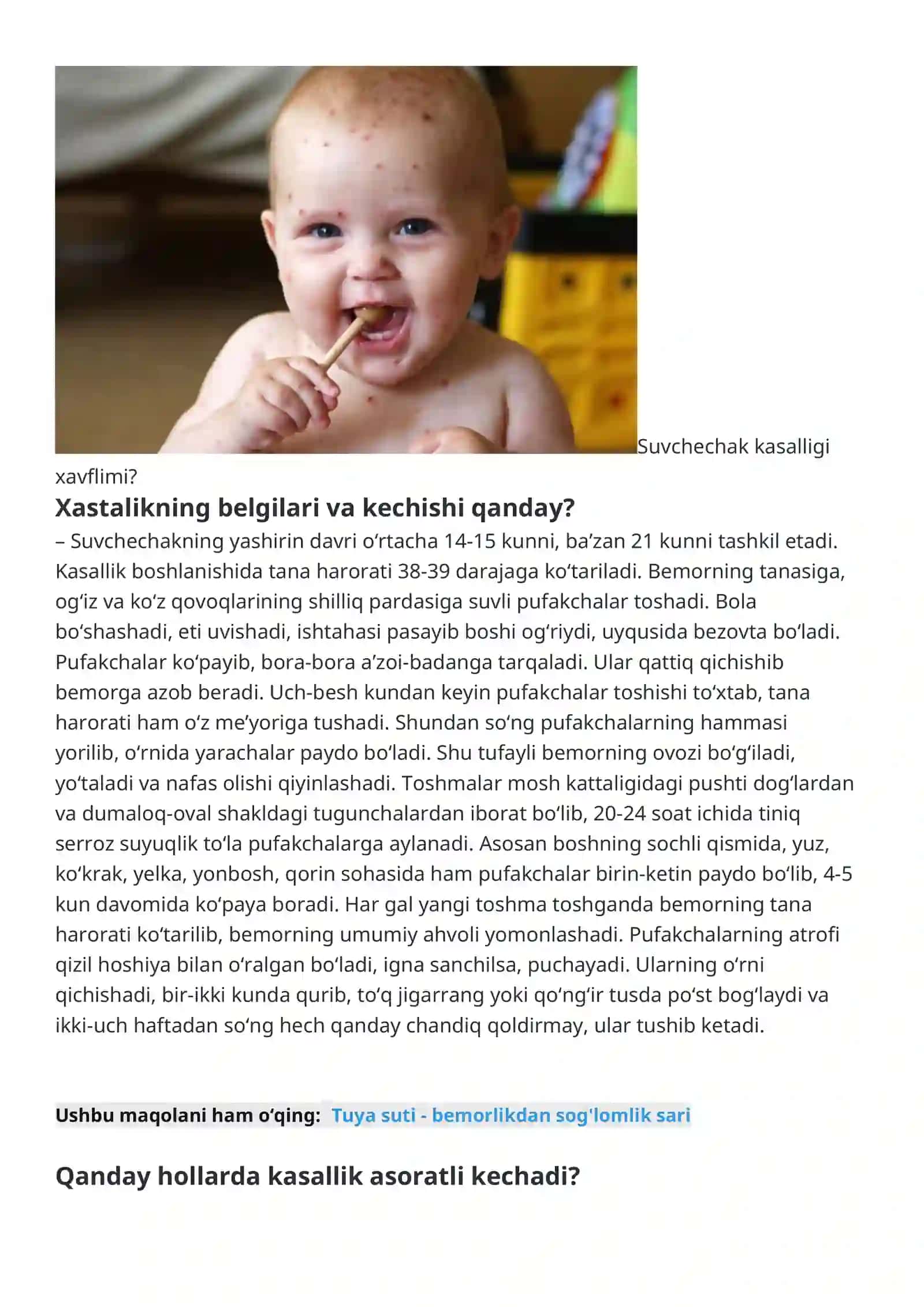 Suvchechak kasalligi 2