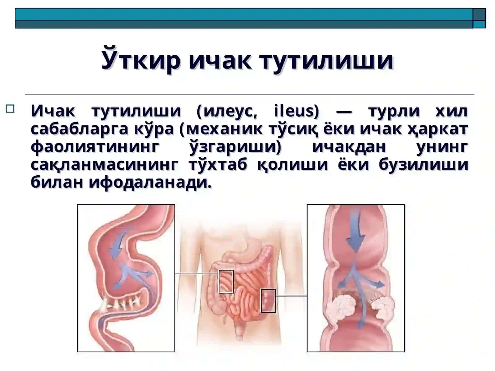 Ўткир ичак тутилиши 2