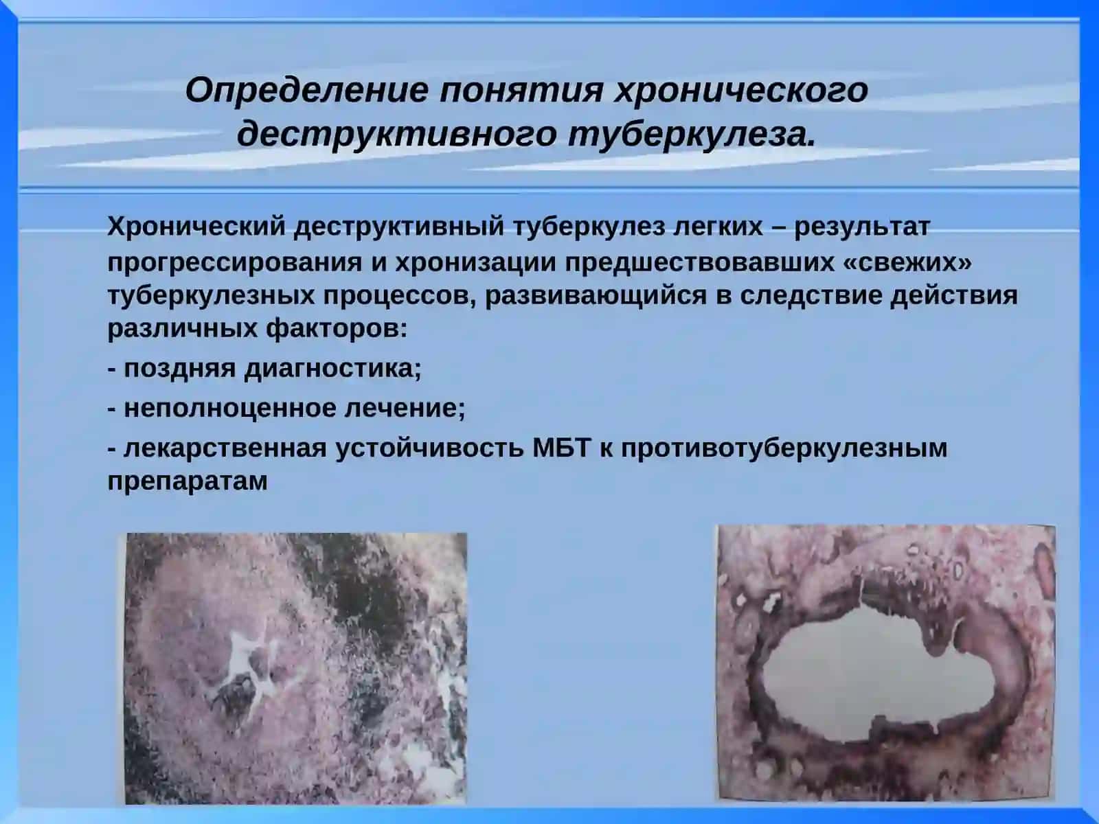 Лекция № 12: Хронический деструктивный туберкулез легких 2