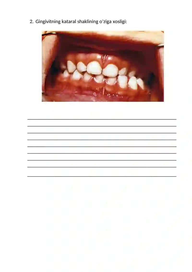 Bolalar o'tkir va surunkali, atrofik, kataral va gipertrofik gingivit. Bolalarda gingivitlarni davolash va profilaktika qilish 2