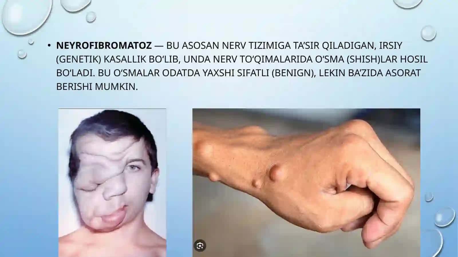 Neyrofibromatoz 2