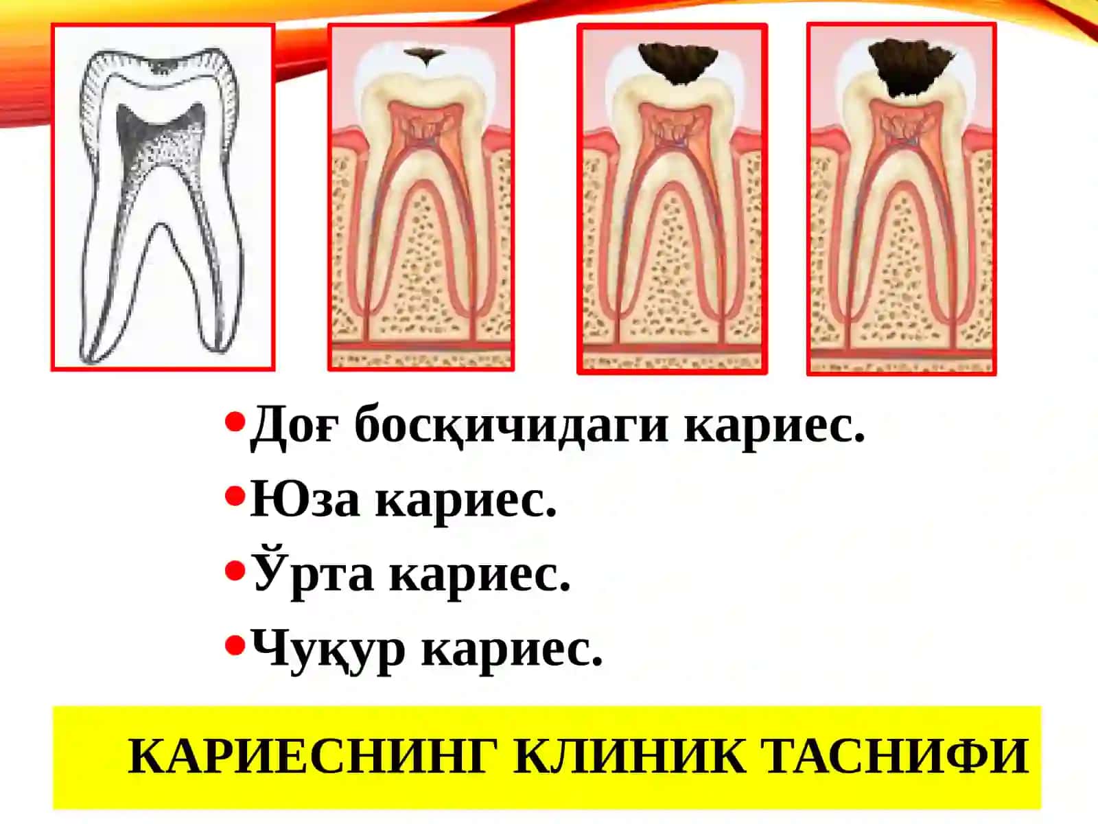 Тиш кариесини даволаш усули 2