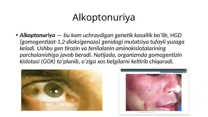 Alkoptonuriyakasalligi 2